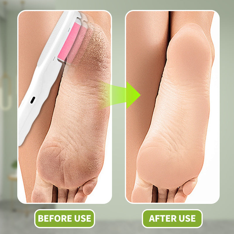Épilateur électrique 2-en-1 pour callosités des pieds et poils